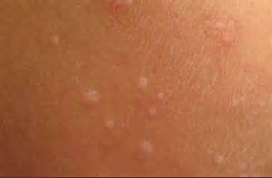 ��ƽ���֢״