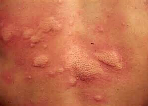 皮肤过敏的病因有哪些