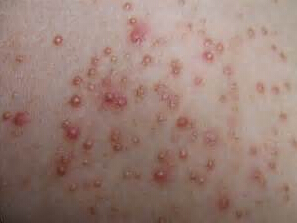 如何治疗毛囊炎