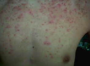 慢性毛囊炎有什么症状