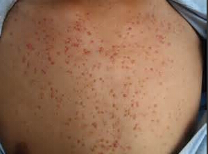 毛囊炎的危害有哪些