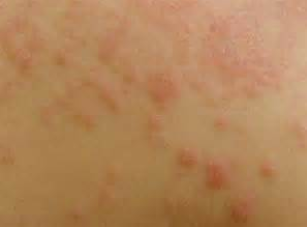 过敏性皮炎的症状特点有哪些