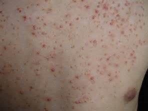 毛囊炎的症状有那些