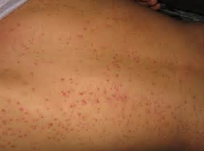 毛囊炎的特点有哪些