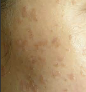 治疗扁平疣好方法