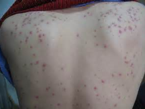 引起毛囊炎的原因